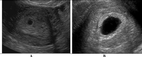 Figure 4 From A Logistic Model Of Early Pregnancy Ultrasound