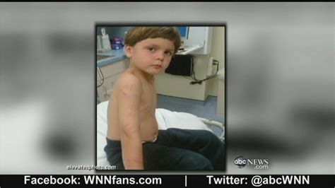 Florida Boy Survives Alligator Attack With Only Scratches Youtube