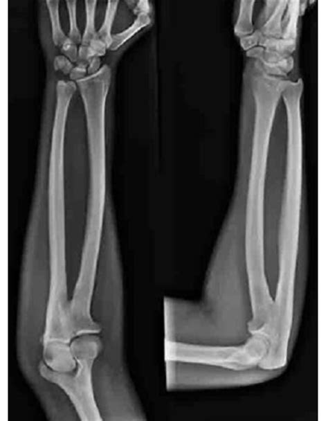 Plain X Ray Anterior And Lateral Views Of The Left Elbow Joint