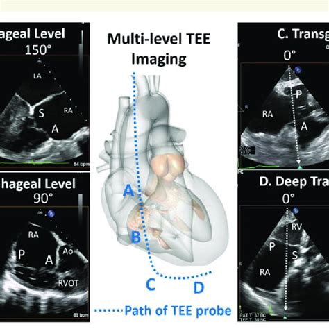 Four Levels Of Imaging For The Tricuspid Valve The Path Of The