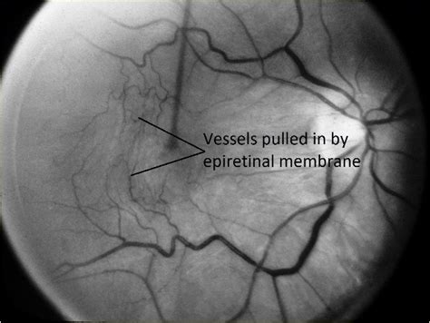 Moran Core Retina Rpe Histopathology