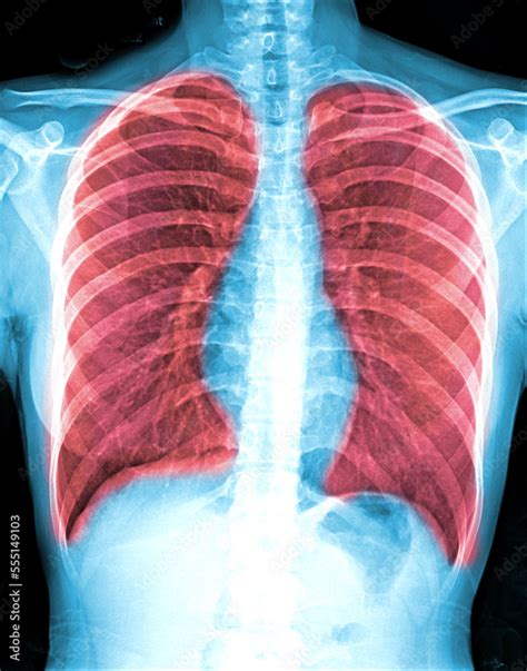 Bronchiectasis . X-ray chest show multiple lung bleb and cyst due to ...