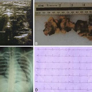 Thyroid ultrasound revealed a hypoechoic lesion with indistinct border ...