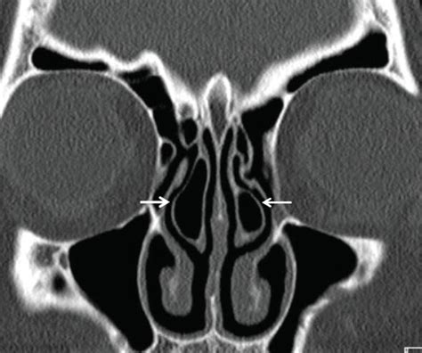 Ct Sinuses Anatomy Anatomical Charts And Posters