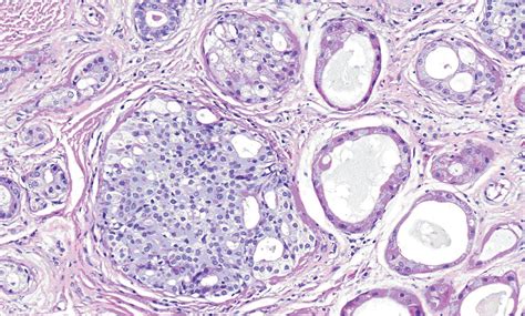 Sclerosing Polycystic Adenosis Of The Parotid Gland Report Of A Case