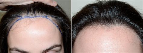 Hair Transplants For Women Before And After Photos Foundation For