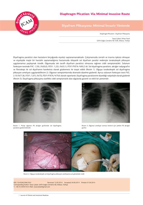 (PDF) Diaphragm Plication: Via Minimal Invasive Route