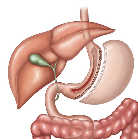 facts    gastric bypass weight loss surgery information