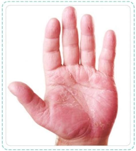 Hand Allergy Causes – Hand Allergy Gloves