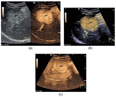 Contrast Enhanced Ultrasonography CEUS Of Liver Masses Principles