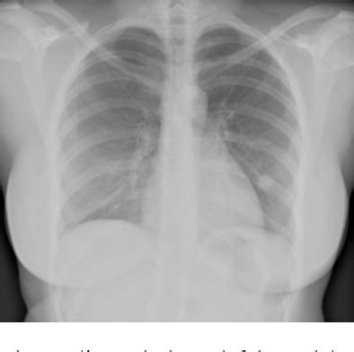 Figure 1 From Diagnostic Challenge Sclerosing Hemangioma Of The Lung