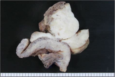 Gross Findings Of The Resected Specimen Of Embryonal Rhabdomyosarcoma