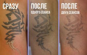 Удаление татуировок