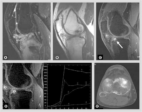 Figure 3 from MRI of bone tumors: advances in diagnosis and treatment ...