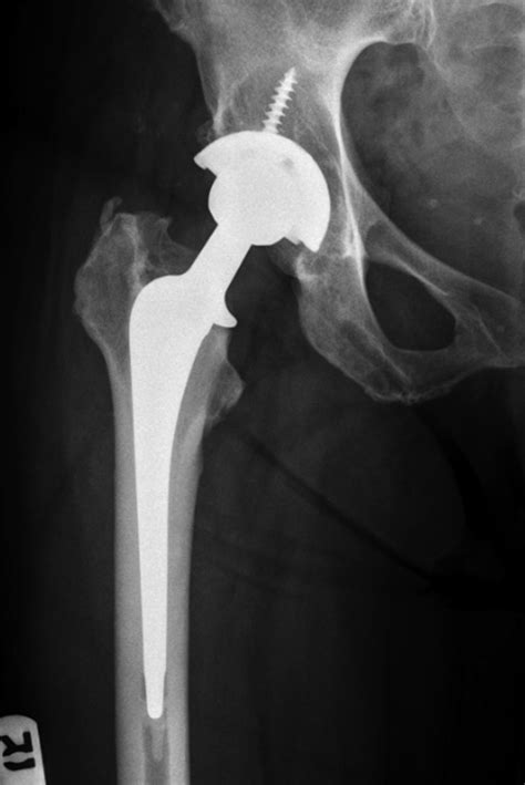 Management Of Acetabular Bone Loss In Revision Total Hip Art JBJS