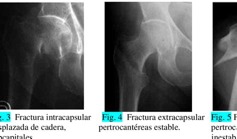 Figure From Morbimortalidad Asociada A La Fractura De Cadera Del