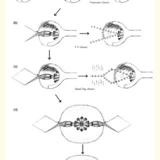 Surgical Algorithm For Anal Stenosis Adapted From Duieb Et Al