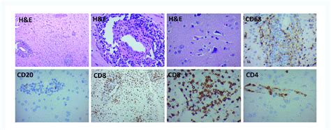 Histopathologic Findings From Brain Biopsy Severe Multifocal