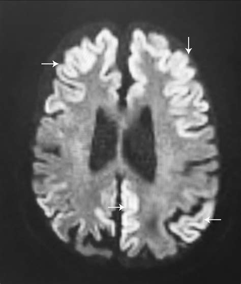 Creutzfeldt Jakob Disease