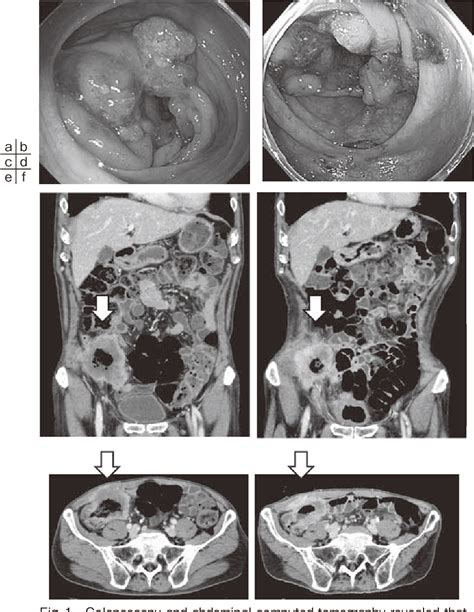 Figure 1 From Laparoscopy Assisted Ileocecal Resection For Cecal Cancer