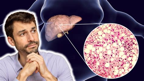 How To Reverse A Fatty Liver Youtube