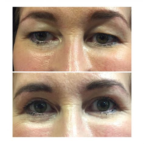 Eye Bag Removal Surgery Q A Transform