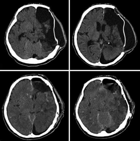 Computed Tomography Scans In Case 2 A And B Preoperative Axial Download Scientific Diagram