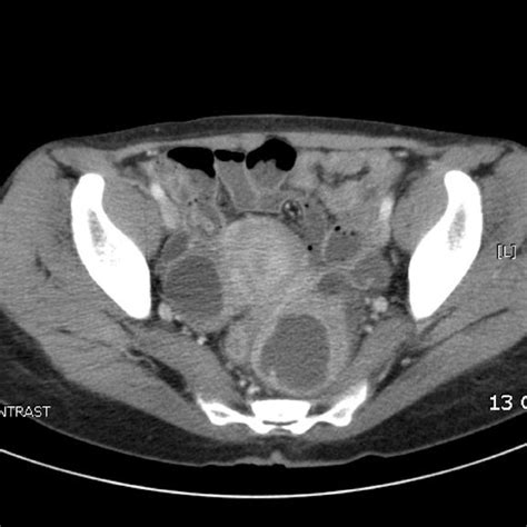 Preoperative Abdominal Ct Shows A Multilocular Cystic Mass In The Left