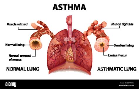 Human Anatomy Asthma Diagram Stock Vector Image Art Alamy