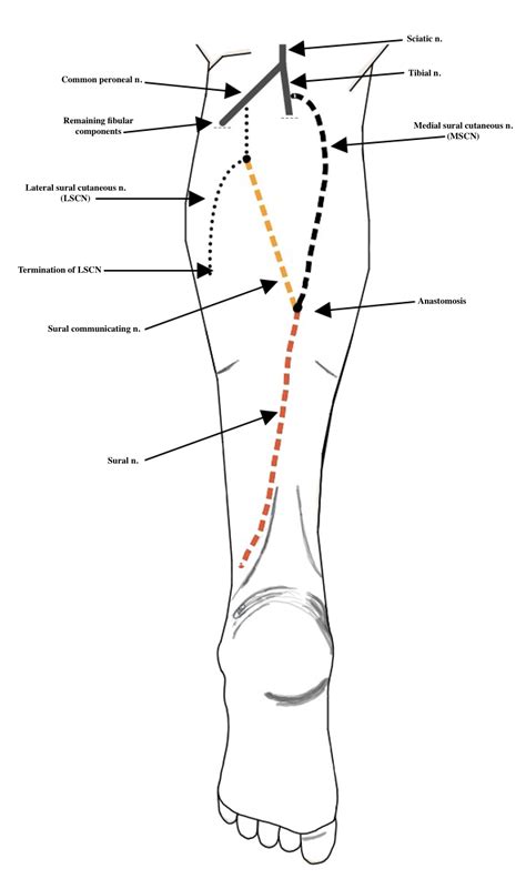 File:Sural nerve formation.jpg - Wikimedia Commons