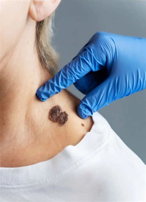 Mole Removal In Rochester Dermatologist Mole Removal