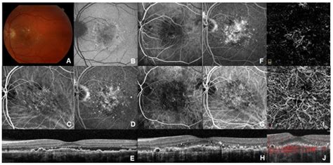 Choroidal Neovascular Membrane Oct