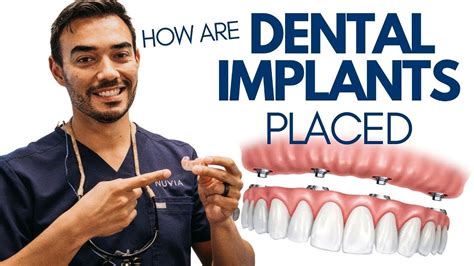 5 Things To Expect During Dental Implant Surgery Youtube