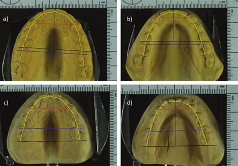 Landmarks On Study Models For Arch Dimensions A Permanent Maxillary