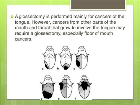 Glossectomy presentation