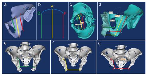 J Orthop Surg Res髋臼四边形钢板倾斜角 数字化测量及新解剖学概念的临床应用 MedSci cn