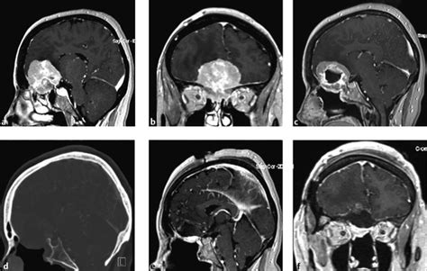 Olfactory Groove Meningiomas Neupsy Key