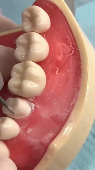 Tooth Prep For A Lower Premolar Crown Dentalshorts Dentalcrowns Dentaleducation Youtube