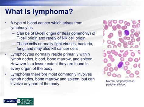 Ppt Lymphoma Overview Powerpoint Presentation Id4501266