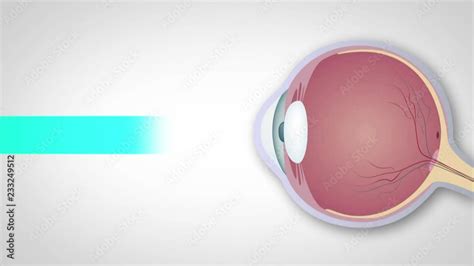 Schematic Representation Of Hyperopia Myopia And Astigmatism