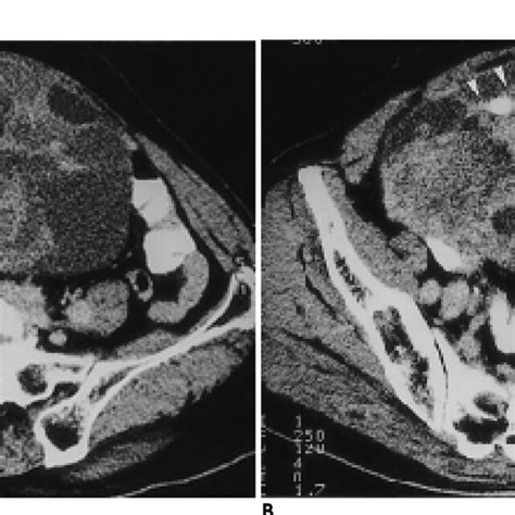 71 Year Old Woman With Left Mucinous Cystadenocarcinoma A Contrast