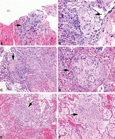 Transbronchial biopsy results from patients A–D and F. (Table 2) The... | Download Scientific ...