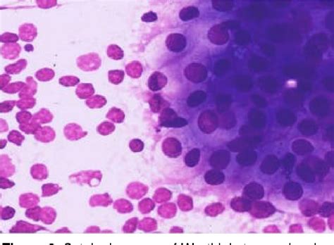 Figure 2 From Fine Needle Aspiration Cytology Of The Salivary Glands A