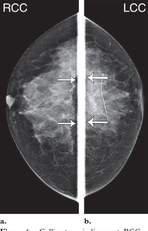 Figure 6 From Digital Mammographic Artifacts On Full Field Systems