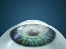 Cornea guttata - Micro Chirurgia Oculare