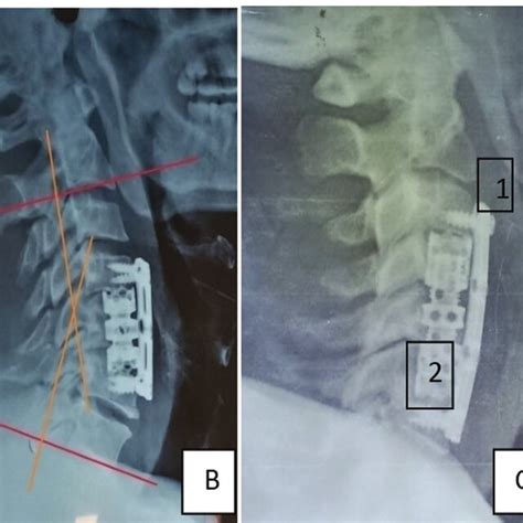 A Preoperative Evaluation Of Cervical Lordosis And Kyphotic Deformity