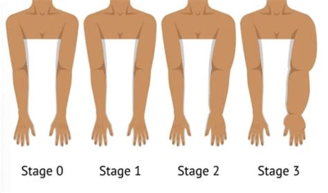 Chronic Venous Insufficiency Vs Lymphedema 5 Differences