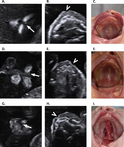 Undetected Anomalies In Foetuses With A Prenatal Diagnosis Of Isolated