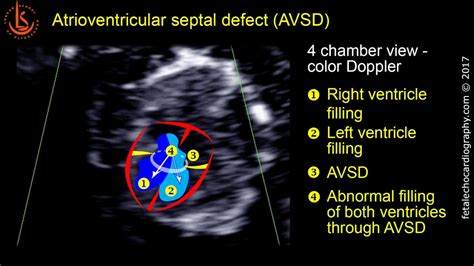 Atrioventricular Septal Defect