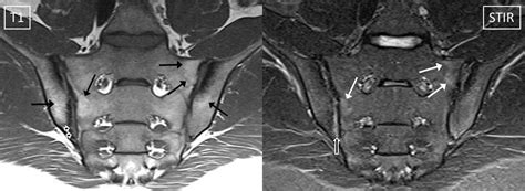 Sacroiliitis ankylosing spondylitis | Variety